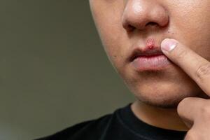 herpes virus en infectie behandeling. mannen lippen getroffen door herpes blaren foto