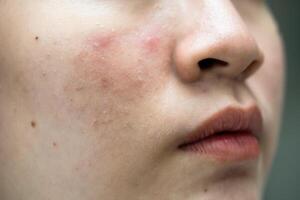 Aziatisch jong met puistje, acne, litteken Aan huid, gelaats probleem. foto