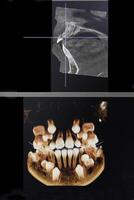 ct beeld van de tanden van een 9 jaar oud kind, met baby tanden, in verschillend projecties. cbct van twee kaken. foto