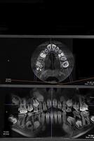 ct beeld van de tanden van een 9 jaar oud kind, met baby tanden, in verschillend projecties. cbct van twee kaken. foto