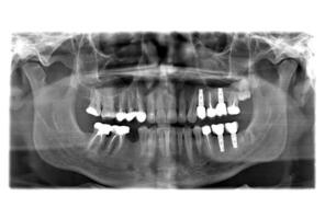 X straal van tanden foto