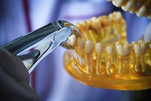 tandarts met een lay-out van de menselijk kaak is tonen hoe naar extract een ziek tand met tandheelkundig tang. foto