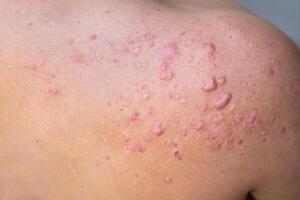 achterhoofd acne in een tiener- jongen genezen, littekens van tiener- acne Aan de schouders, huid infecties en allergieën naar de lichaam van een Mens, gezondheidszorg en medisch concept foto
