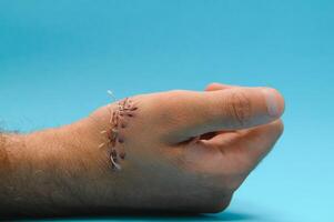 wond hand, hechten de wond. de type van besnoeiing na chirurgie. foto