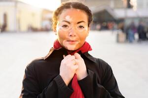 een mooi jong meisje van Afrikaanse etniciteit met vitiligo staand Aan de warm voorjaar stad straat gekleed zwart jas foto