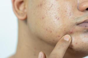 huid problemen. probleem van ontstoken acne Aan de gezicht. ontstoken acne bestaat van zwelling, roodheid, en poriën dat zijn ernstig verstopt met bacteriën, olie, en dood huid cellen. foto