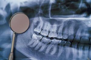 panoramisch kaak röntgenstraal met tandheelkundig spiegel. tandheelkundig behandeling concept. detailopname. foto