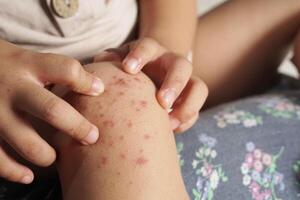 dichtbij omhoog visie van jongen tonen zijn knie geïnfecteerde met hand- voeten en mond ziekte of hfmd afkomstig van enterovirus of coxsackie virus, foto