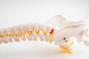 spinal zenuw en bot, lumbaal wervelkolom verplaatst hernia schijf fragment, model- voor behandeling medisch in de orthopedische afdeling. foto