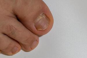 schimmel nagel infectie onychomycose droog grof huid van de poten foto
