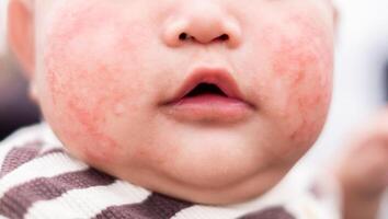 rood uitslag met jeuk ten gevolge stof of allergie Aan baby gezicht, schimmel, allergie, dermatologisch ziekte, droog huid. gezondheidszorg en medisch concept. foto