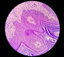 histologisch microfoto. prurigo nodularis of pn is een chronisch wanorde van de huid. foto