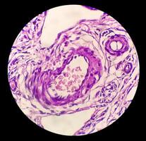 histologie, buikvlies inclusie cyste. paraovarieel cysten, hydrosalpinx en lage score cystic mesothelioom zijn meestal beschouwd in de differentieel diagnose van foto's. foto