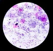 paps smeren analyse, oppervlakkig squameus cel, metaplastisch squameus cel, koilocyten cel. hpv verwant verandering foto