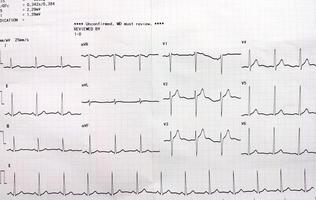 diagram tonen de resultaten van de elektrocardiogram test Aan opname papier. foto