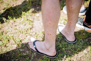 de toerist staat in slippers, menselijk poten gebeten door een mug, sporen van mug bijt, zeer poten, foci van huid irritatie. foto