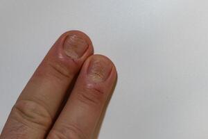 schimmel nagel infectie onychomycose. droog grof huid van de poten foto