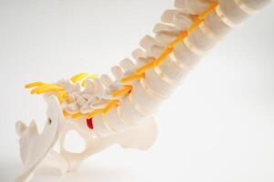 spinal zenuw en bot, lumbaal wervelkolom verplaatst hernia schijf fragment, model- voor behandeling medisch in de orthopedische afdeling. foto