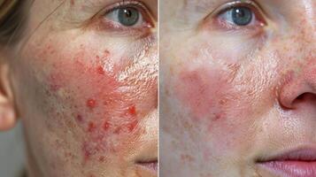 een voordat en na foto tonen significant verbetering in een psoriasis lijders huid na gebruik makend van infrarood therapie.