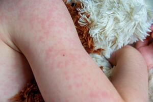virale ziekte. mazelen uitslag Aan de lichaam van de kind. allergie foto