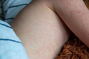 virale ziekte. mazelen uitslag Aan de lichaam van de kind. allergie foto