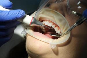 tandarts is aan het doen intraoraal scannen voor vrouw voordat installeren keramisch fineer en kronen. orthodontist houdt in zijn hand- een handleiding 3d scanner voor de kaak en mond. prosthodontie concept. foto