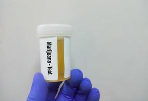 medisch laboratorium urinecontainer met urinemonster voor drugstest cocaïne. diagnose van illegale drugscocaïne in de urine. foto