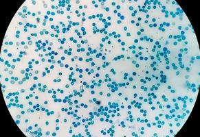 close microscopisch beeld van abnormaal aantal reticulocyten op de afdeling hematologie, methyleenblauwkleuring foto