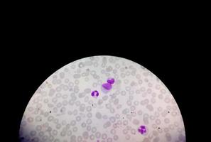 microscopisch beeld van gekleurde dia van hematologie in laboratorium. detailopname. totale bloedbeeld. foto