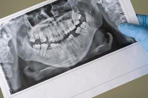 tandheelkundige röntgenfoto. een panoramische röntgenfoto van een mond, met rood pijnlijk gebied. foto