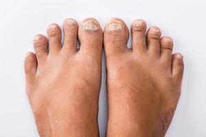 psoriasis die pedicure op witte achtergrond foto