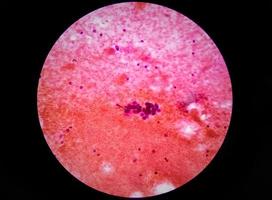 gemetastaseerd adenocarcinoom van de long. pleuravochtcytologie van long papillair adenocarcinoom, een type niet-kleincellig carcinoom foto