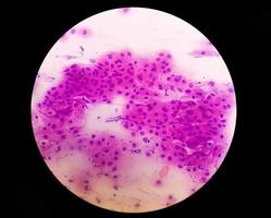 pap's uitstrijkje pap vlek microscopisch 40x zoom toont hoogwaardige squameuze intra-epitheliale laesie is een pre-cancereuze, seksueel overdraagbare aandoening foto