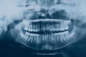 medische röntgenbeeldvorming van menselijke tanden van een kind foto