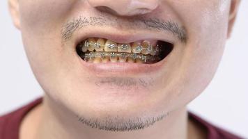 close-up van de mond van de mens met beugels, gele tandplak omdat regelmatig koffie wordt gedronken foto