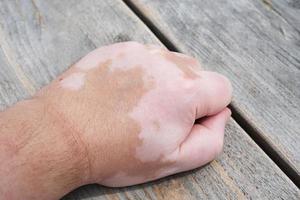 mannenhand met vitiligo huidaandoening foto