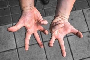 neurologische aandoening, gevoelloosheid van de handen van de patiënt, bewegingsstoornis van spieren en pezen foto