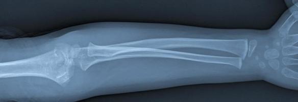 gebroken arm xray foto