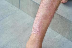 ernstige psoriasis op het been van een man close-up foto