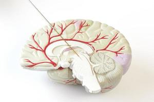 miicro-elektrode opname op het hersenmodel. bij de ziekte van parkinson chirurgie foto