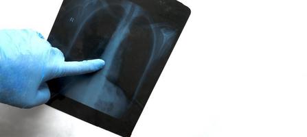 de dokter wijst een vinger in een beschermende handschoen naar de longschade bij coronavirus-pneumonie, copyspace foto