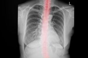 röntgenfoto van de borst. röntgenfoto van menselijke borst voor een medische diagnose. foto