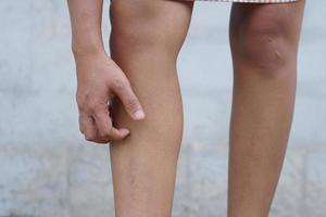 vrouw jeukende huid op been foto