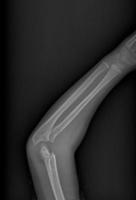 gebroken arm xray foto