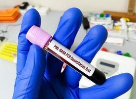 pml-rara kwantitatieve test in pcr-laboratorium. het geeft een algemene schatting van het aantal pml-rara-gensequenties dat aanwezig is in iemands bloed- of beenmergmonsters. promyelocytische leukemie. foto