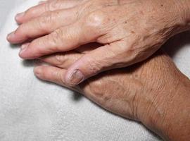 vingernagel van een oudere vrouw besmet met een schimmelinfectie. foto