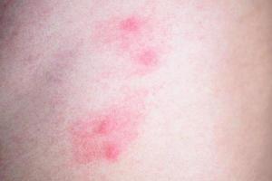 huidallergie door muggenbeten foto