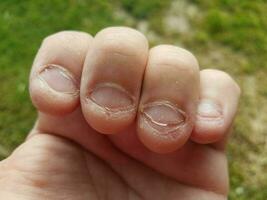 gebeten vervelende ongezonde grove gekauwde vingernagels slechte gewoonte foto