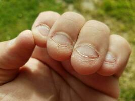 gebeten vervelende ongezonde grove gekauwde vingernagels slechte gewoonte foto