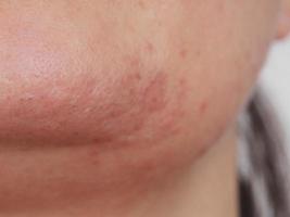close-up van een slechte huid foto